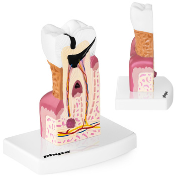 Model anatomiczny chorego zęba człowieka w skali 6:1